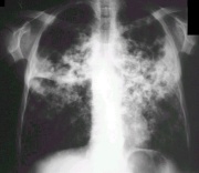 Tuberkulóza viditelná na skiagramu hrudníku